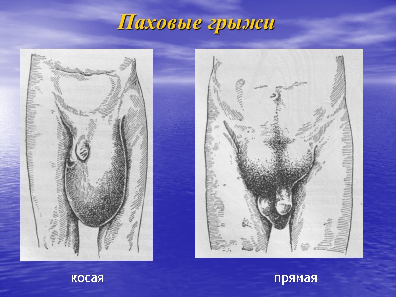 Паховые грыжи косая прямая